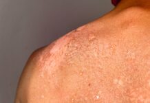 Protected: Bridging the gaps in Psoriasis diagnosis and treatment for people of colour