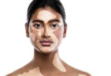World Vitiligo Day – Cultural Stigmas Surrounding Chronic Skin Conditions